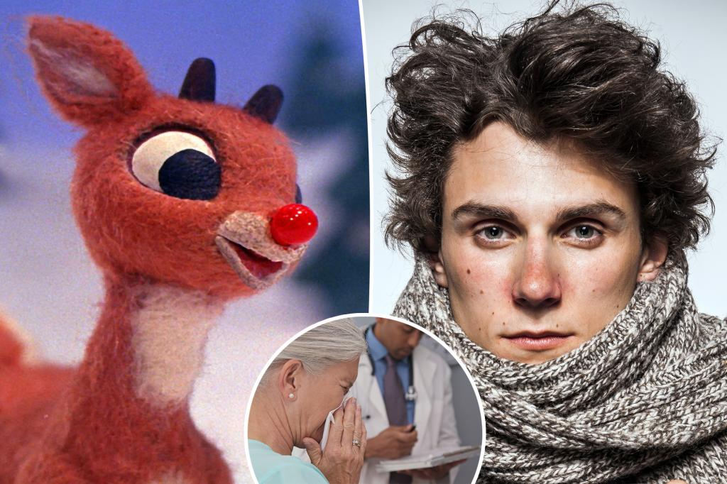 Rudolph's red nose sign is a sign of this nasal infection